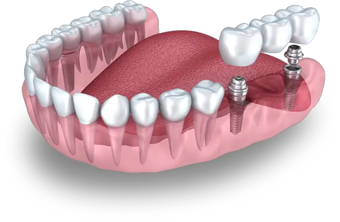 fogbeültetés implantátummal